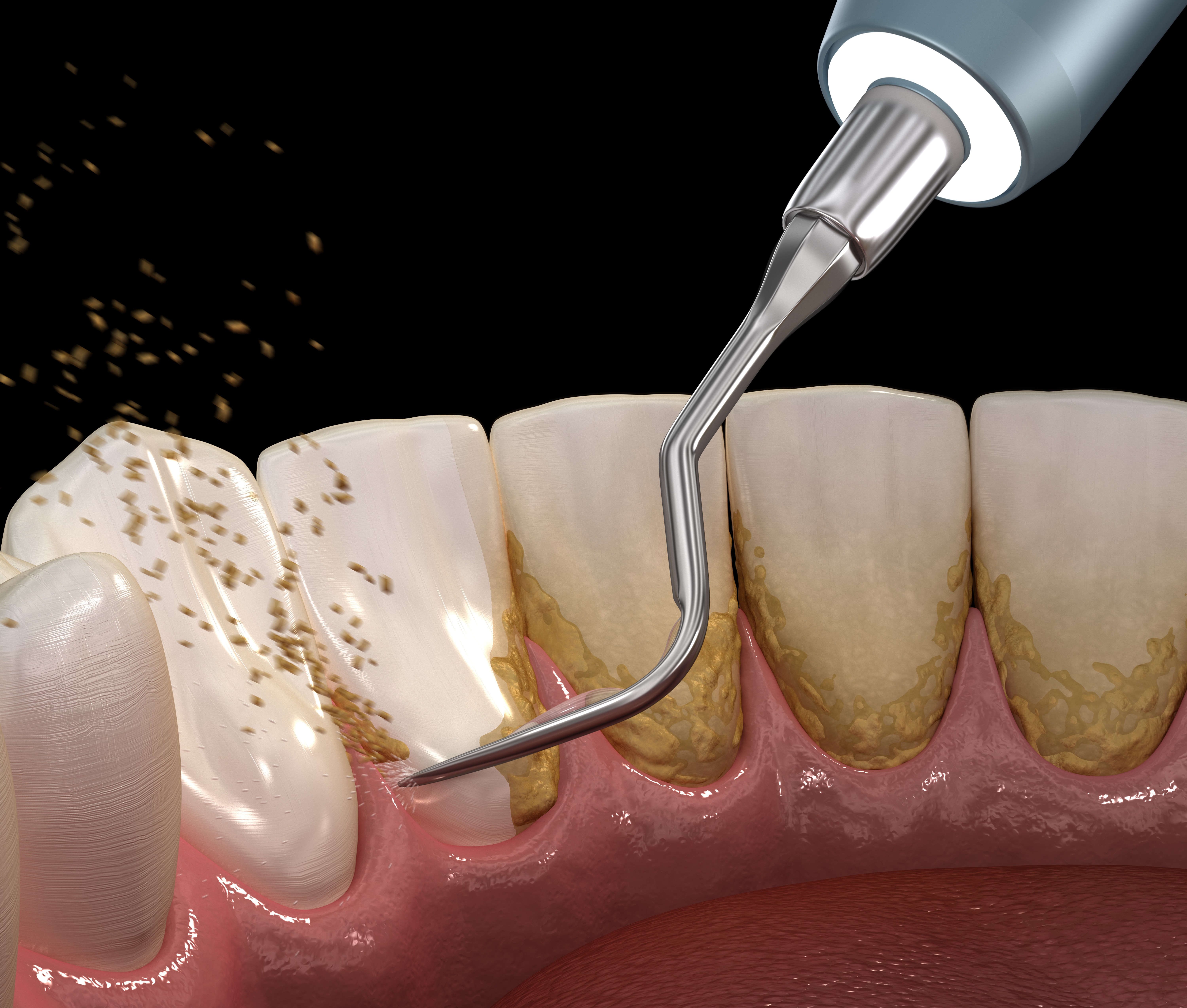 Baxter Dentist Explains How We Clean Your Teeth - Baxter, MN